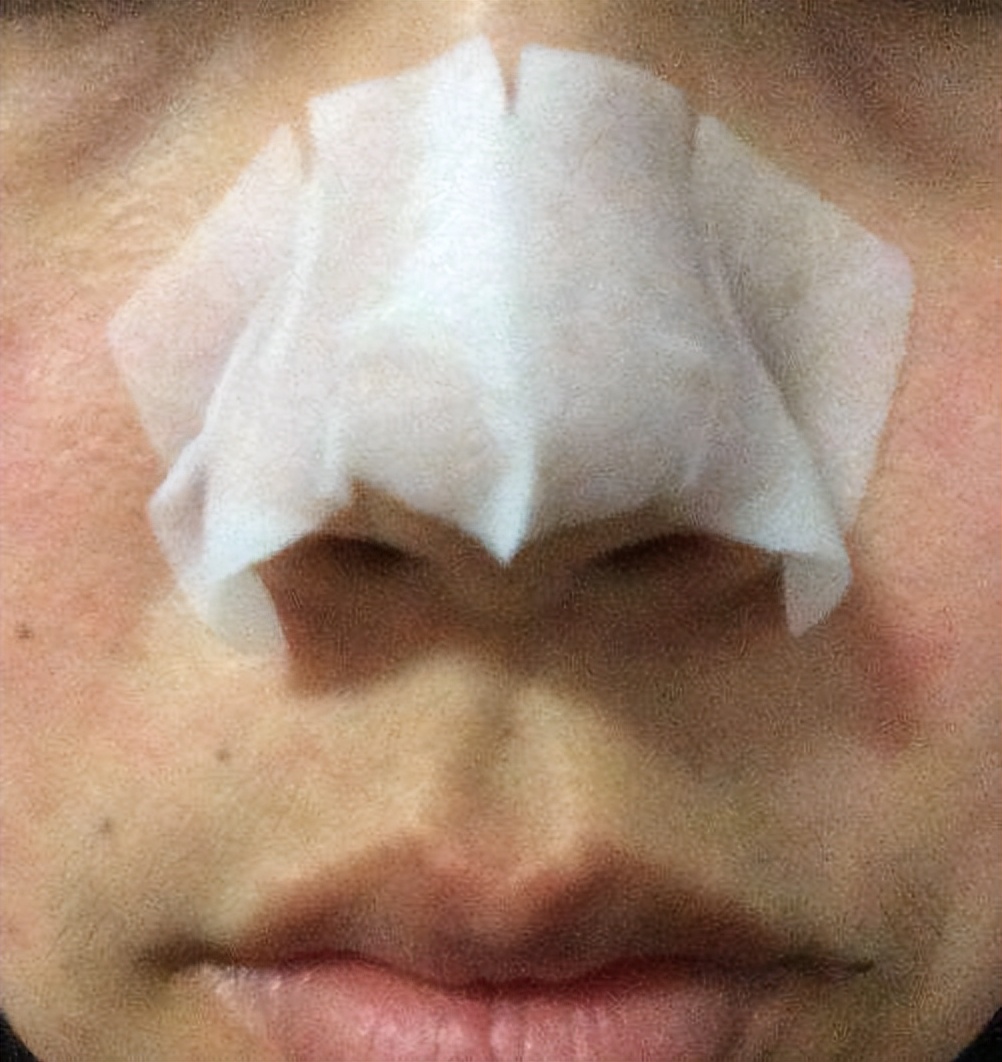 鼻头长黑粉刺怎么回事图片,鼻梁及两侧起了闭口粉刺