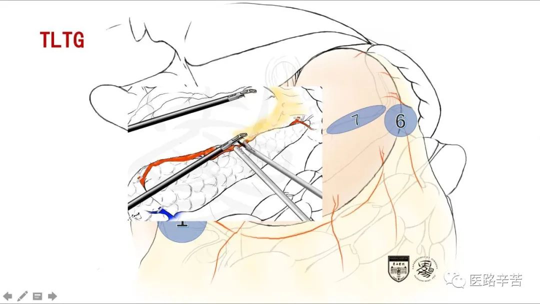 全腹腔镜胃癌根治术，学习大咖怎么清扫淋巴结