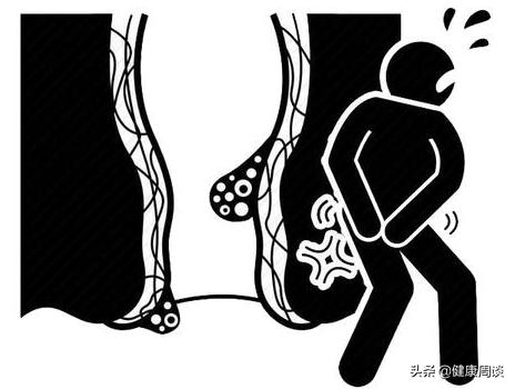 肛门脱出的肉球是怎么回事,肛门脱肛的症状怎么治疗