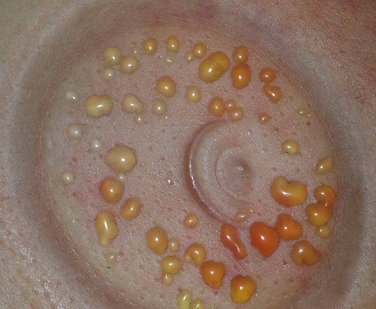 老中医拔火罐的正确方法,中医提醒拔火罐警惕四个禁忌