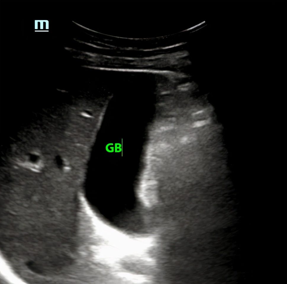 超声所见正常范围准确吗,超声看不清楚