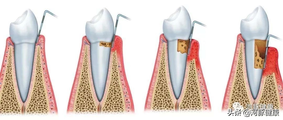 刷牙时牙龈出血要警惕,刷牙时牙龈出血牙膏会进入血液吗