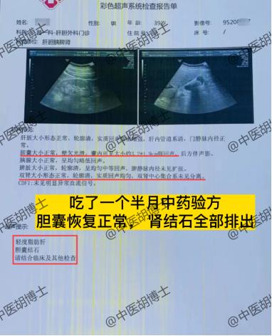 胡博士治疗病案分享：胆囊结石伴肾结石、一个半月验方效果明显