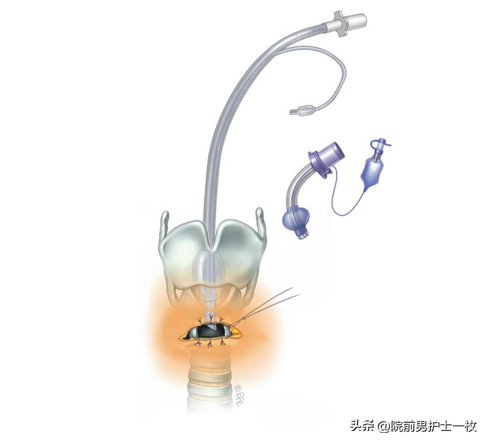 关于气管切开技术流程及注意事项