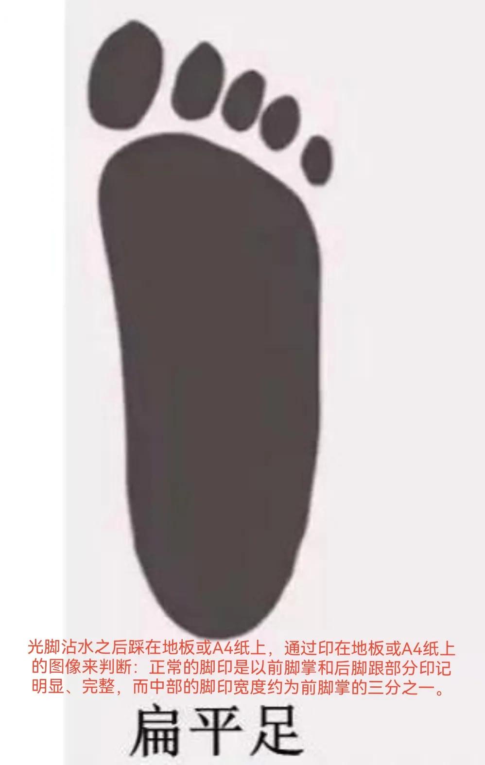 扁平足发病机制,扁平足诊断标准示意图