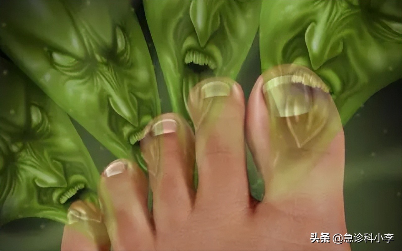 脚气反反复复怎么才能治好,脚气总是反反复复怎么治