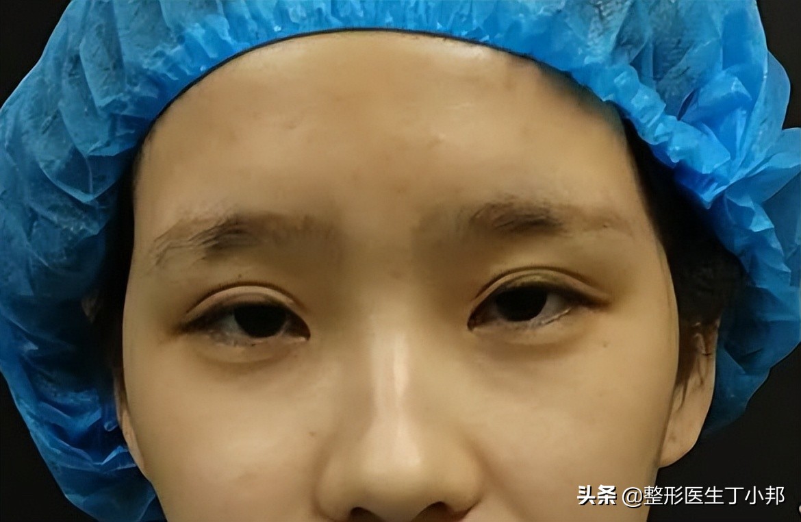 16岁，想做韩式三点双眼皮？需要开眼角吗？整形医生丁小邦解答