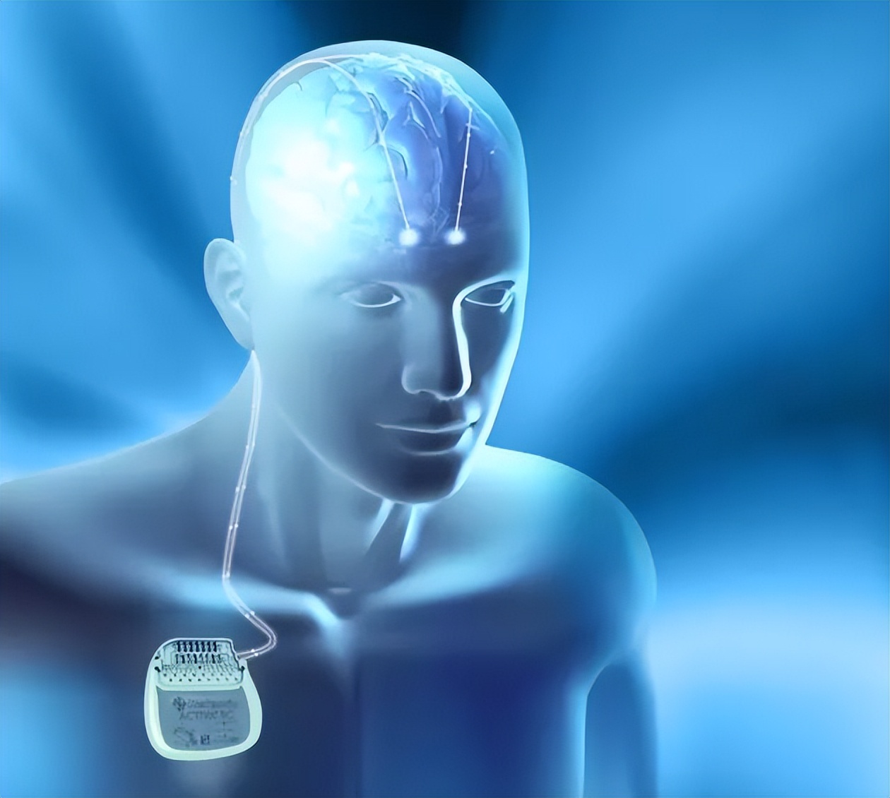 最好的脊髓电刺激器,脊髓刺激器治疗瘫痪