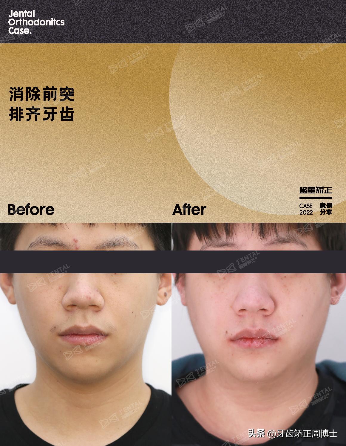 小孩牙齿为什么迟迟不长,孩子牙齿刚长出来不齐怎么办