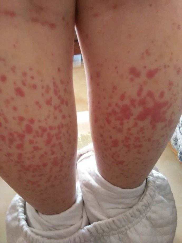 过敏性紫癜伴随一生吗,过敏性紫癜是不是终身不愈