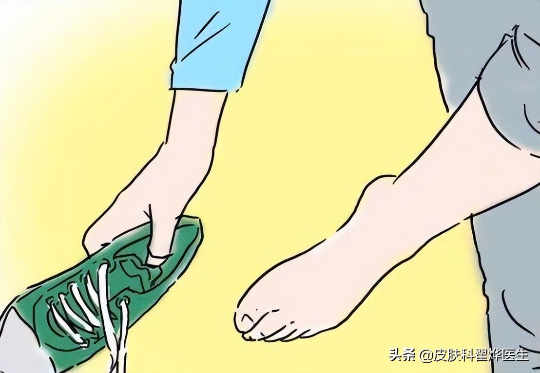 跖疣鸡眼和脚底胼胝怎么治疗,胼胝鸡眼或者跖疣要怎么治