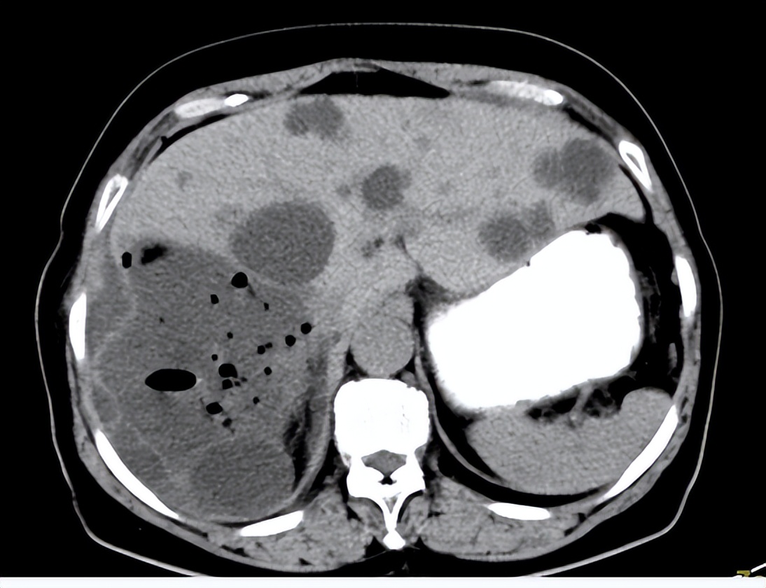 专家讲解多发肝囊肿治疗视频,多发性肝囊肿适合什么手术