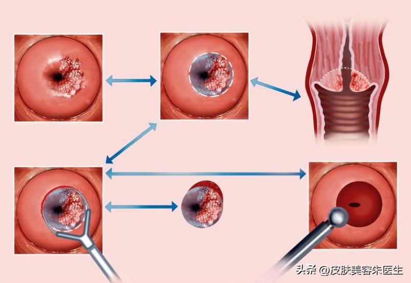醋酸白试验一定是湿疣吗,醋酸白试验可能是假性湿疣吗