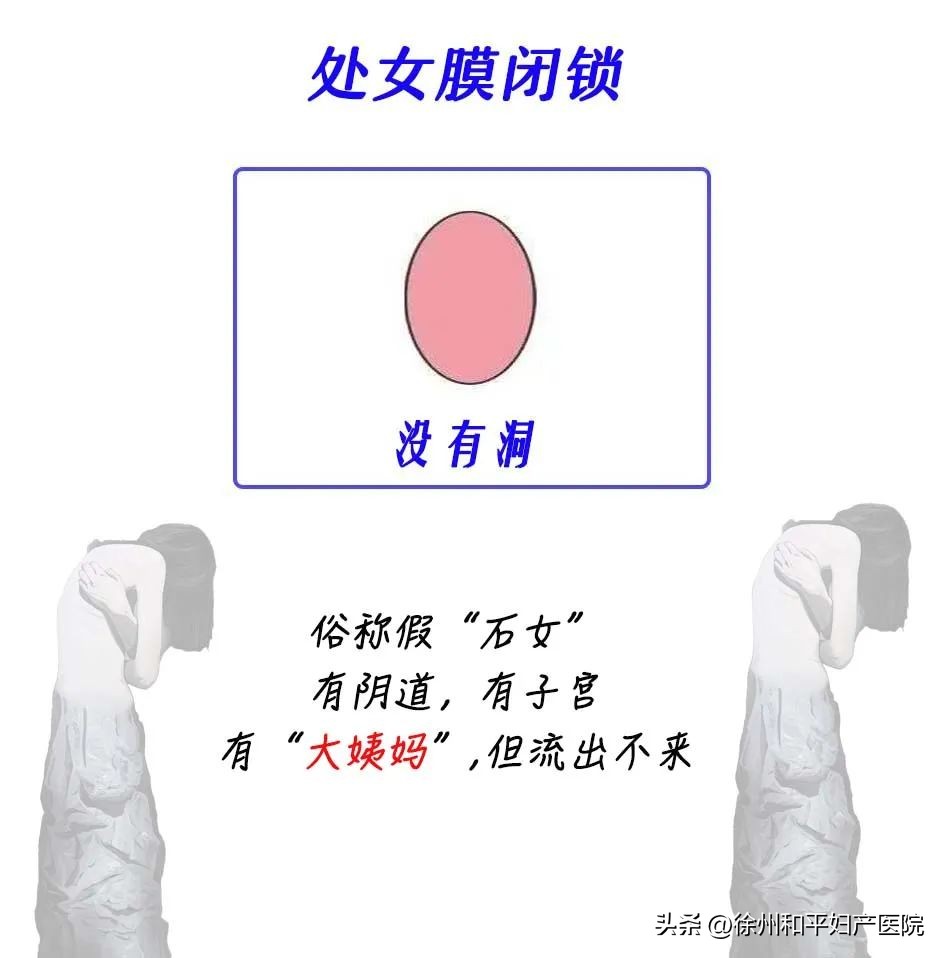 月经“堵”在阴道大半年，积了一瓶矿泉水那么多