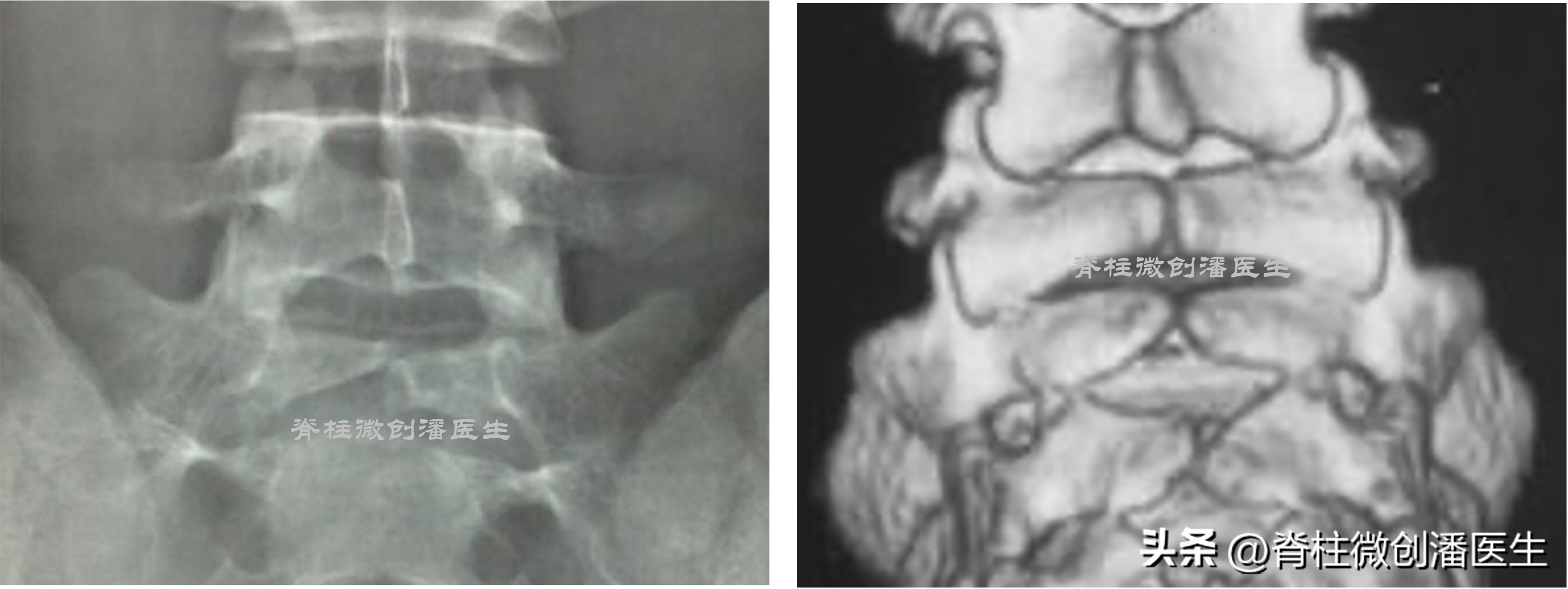 小孩隐性脊柱裂手术,隐性脊柱裂尿床手术要多少费用