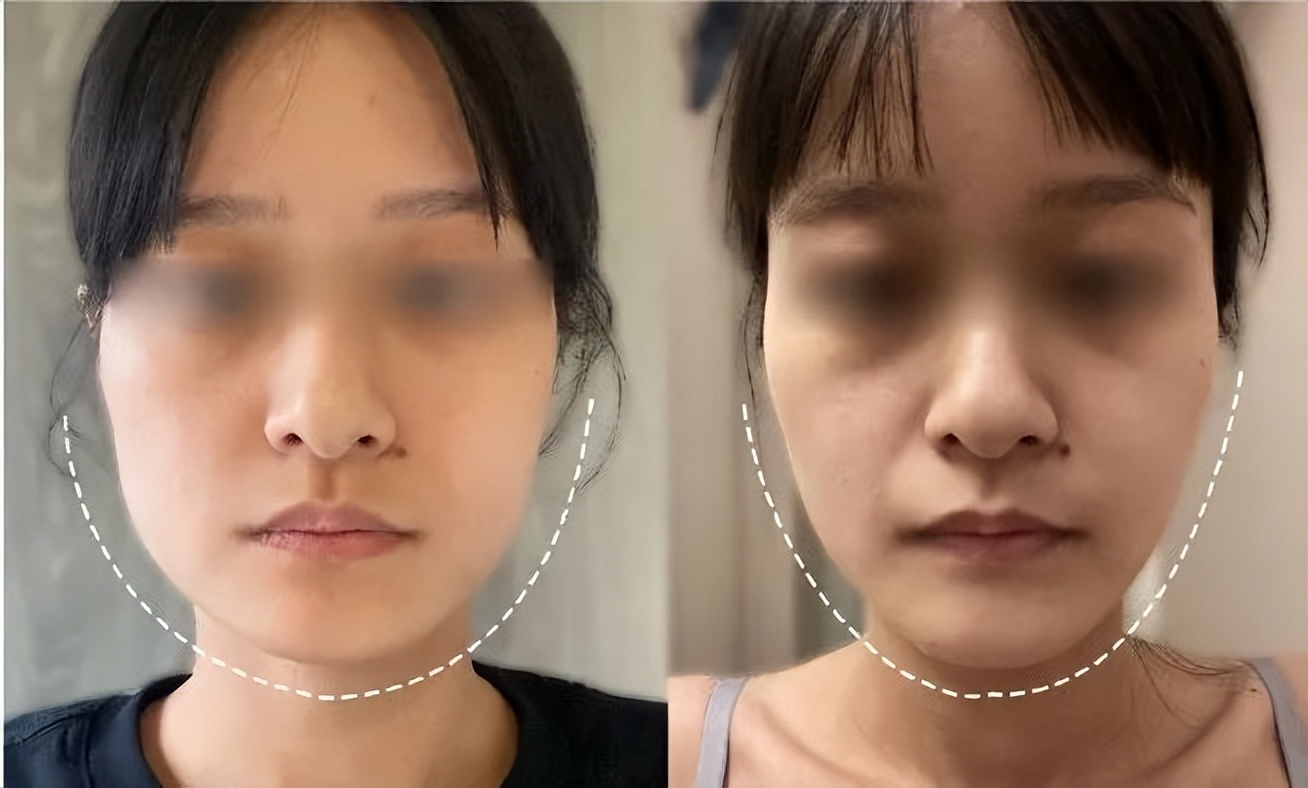 精致小脸的10个方法,精致脸如何变美