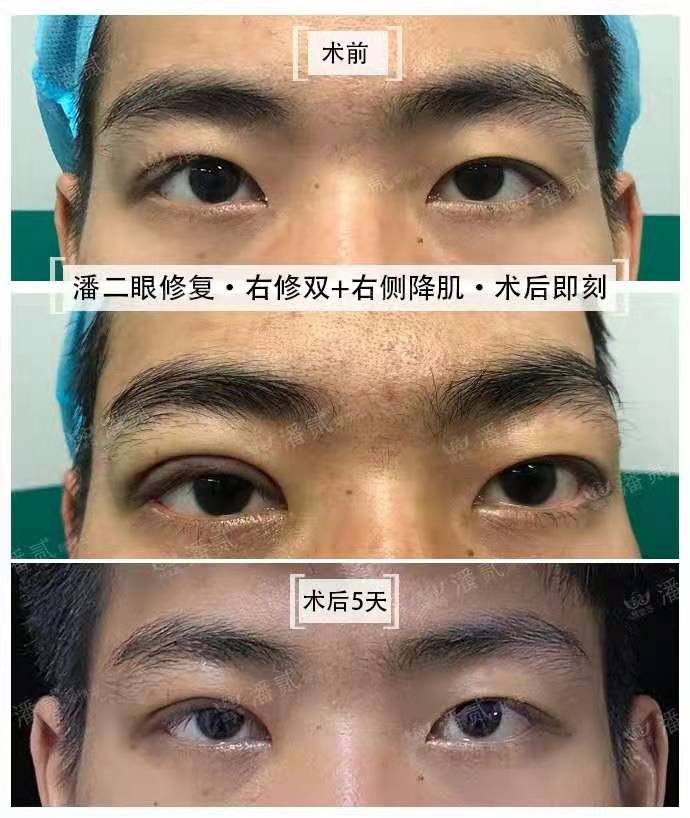 男士割双眼皮恢复全过程,男士割双眼皮手术