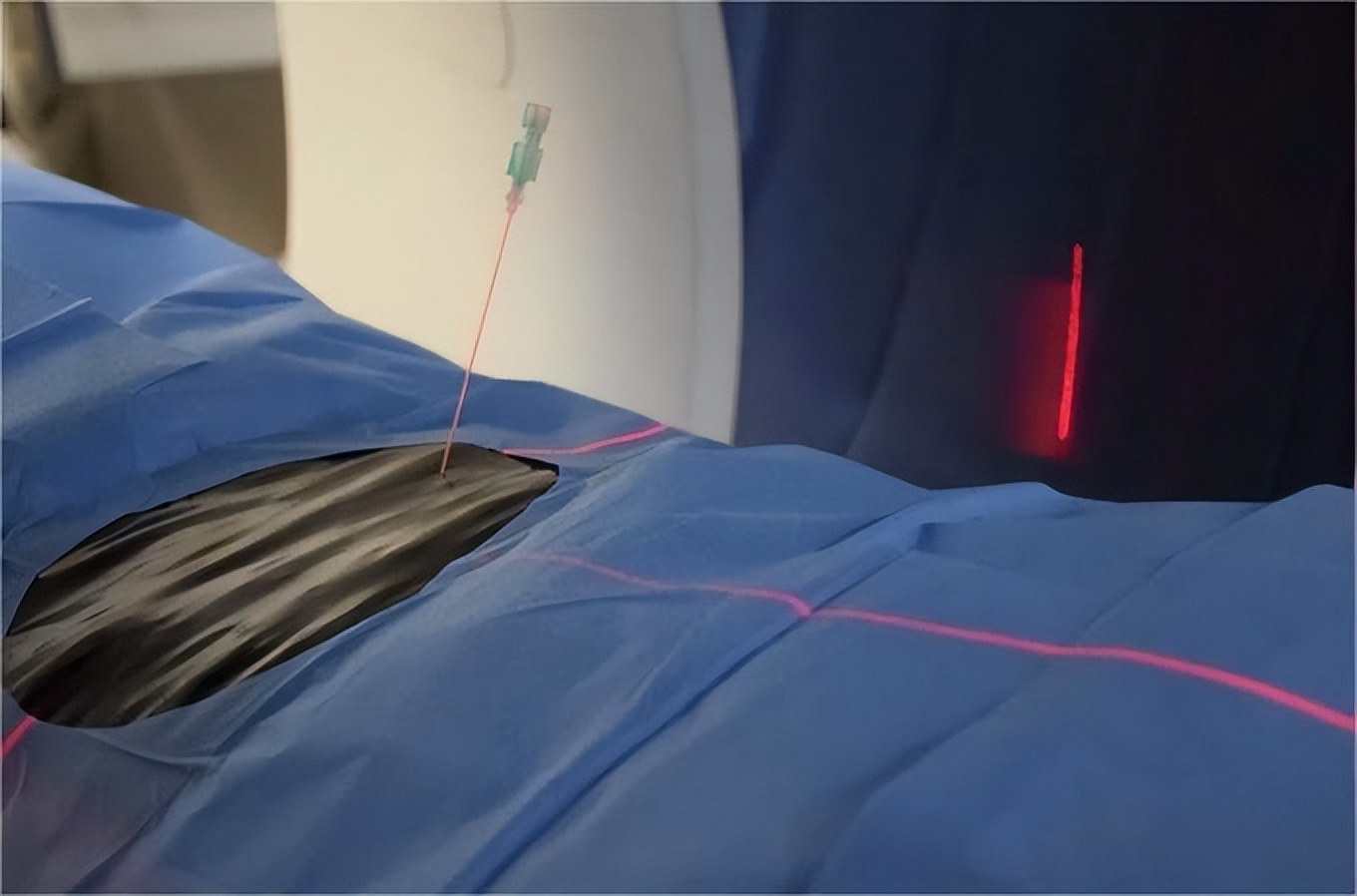 【病例档案馆】介入快报（第2期）