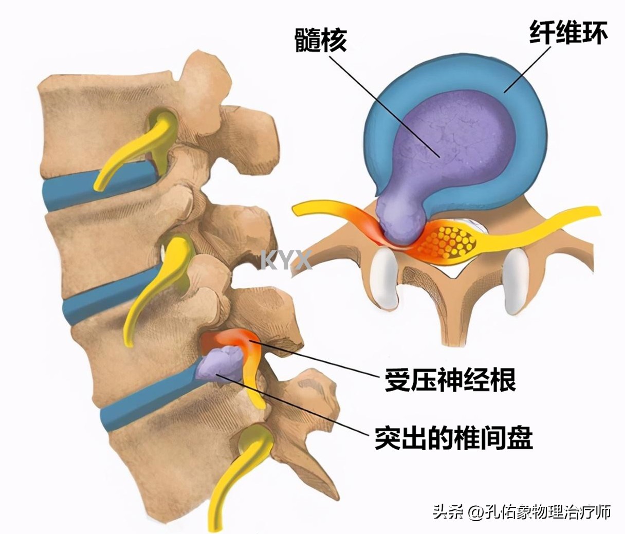 从臀部到小腿麻木疼痛怎么回事,臀部小腿酸胀是怎么回事
