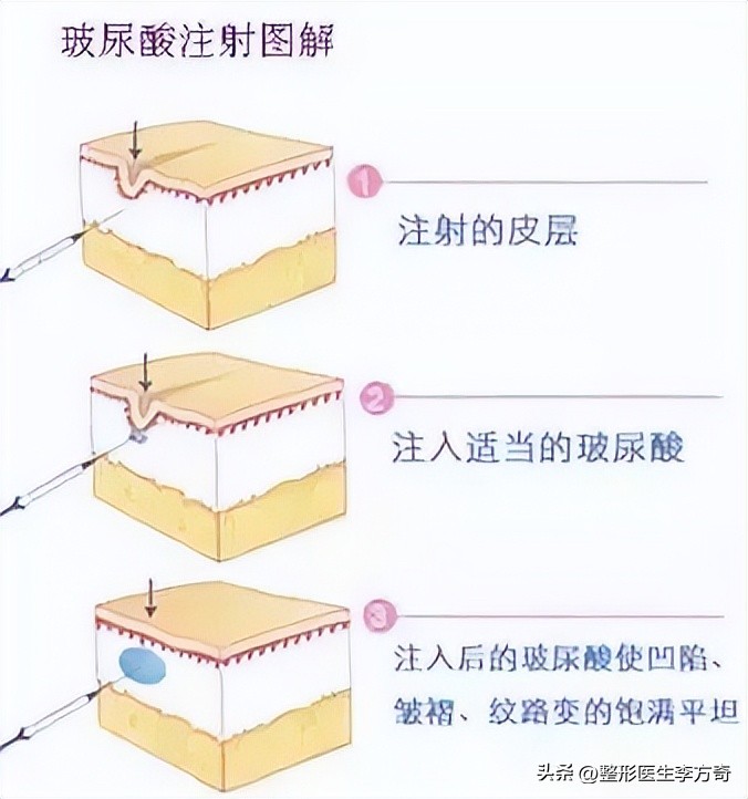 女明星爱美丽化妆品怎么样,玻尿酸功效与作用护肤