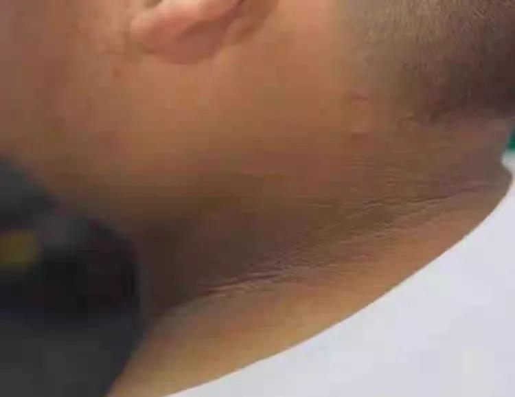 脖子上的纹路叫什么纹,脖子纹路深是什么原因中医