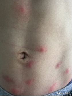 夏天虫咬皮炎的治疗方法,虫咬性皮炎到底如何杀虫