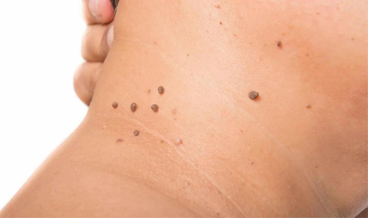 脖子上长了很多丝状疣怎么去除,脖子上长的小疙瘩丝状疣怎么治