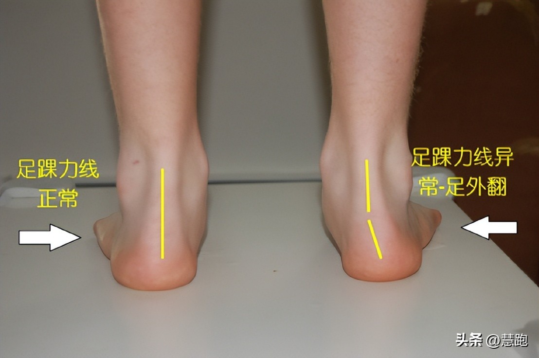 跑步减少受伤的5个方法,跑步六大伤痛解决方案