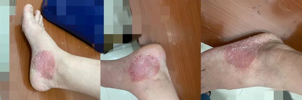 行医笔记：一例掌跖脓疱病的治疗经过