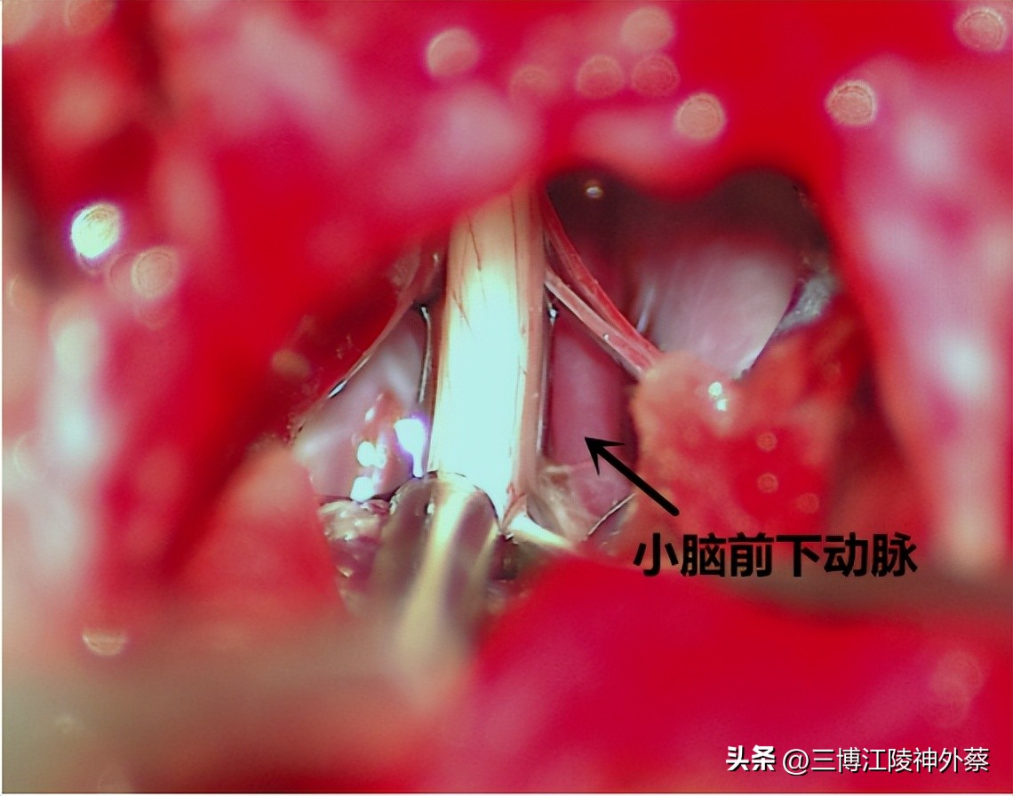 双侧面肌痉挛真实案例,面肌痉挛会发展成三叉神经痛吗