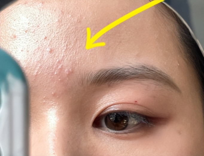 去黑头粉刺去闭口的护肤品,黑头闭口粉刺应该如何清理