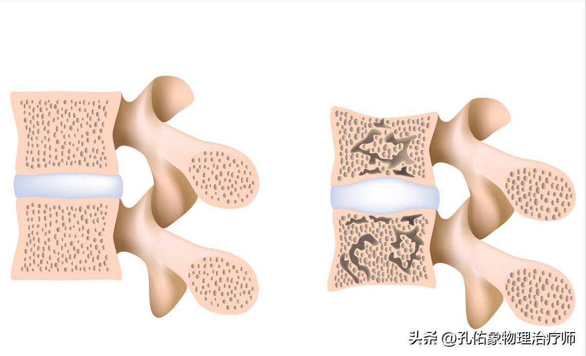 老年人压缩骨折能治好吗,腰椎压缩骨折腰部酸痛怎么办