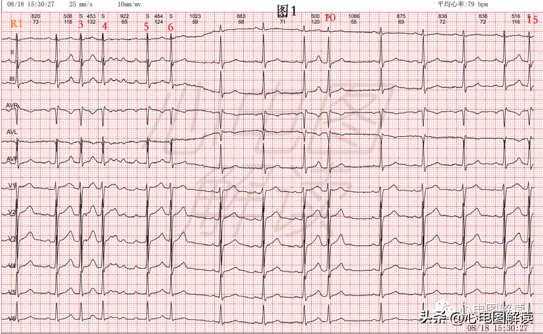 房早室早区别,房早室早房颤