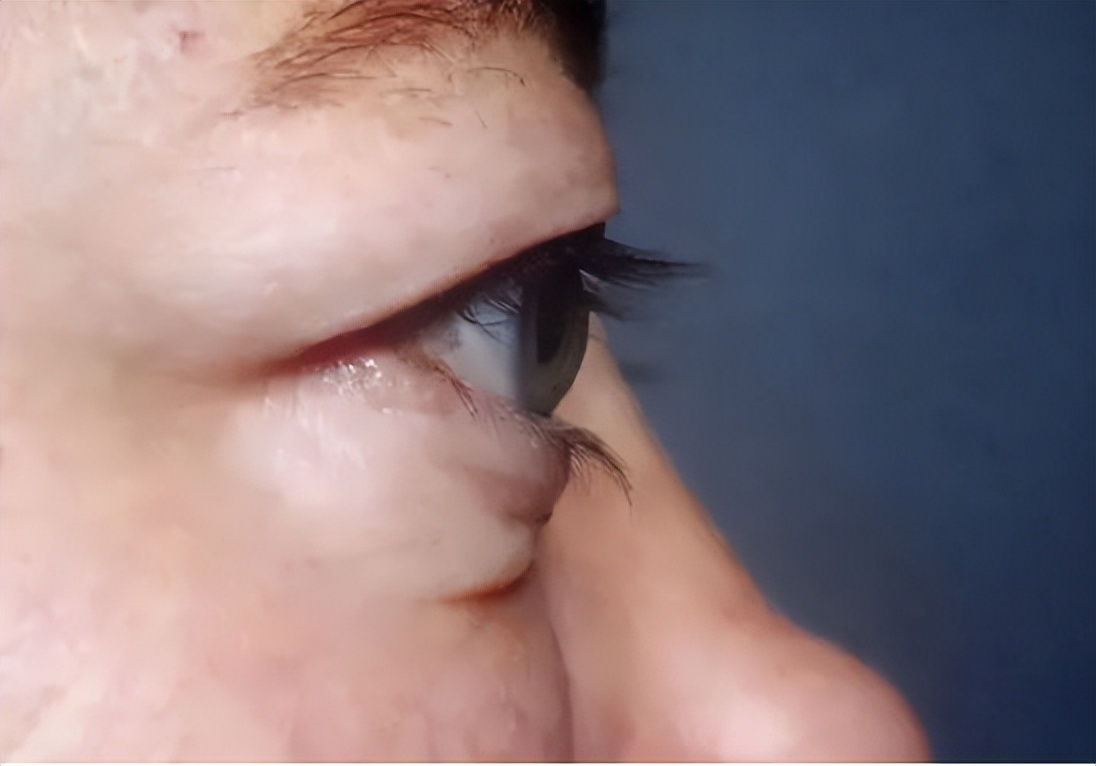 中医甲亢突眼恢复最快方法,甲亢突眼症应该怎么养护眼睛