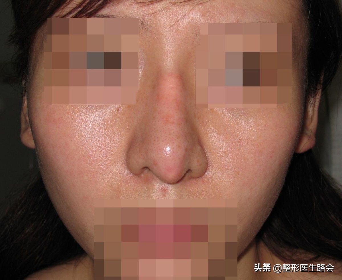 硅胶隆鼻5年歪了怎么修复,隆鼻10天歪了可以矫正吗