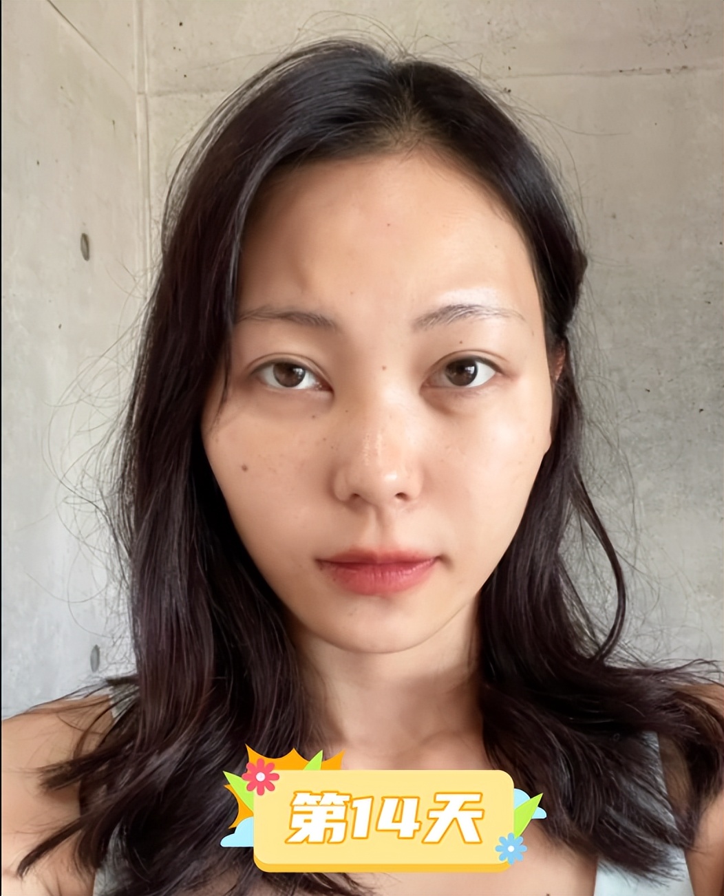 内切去眼袋手术全过程,做了去眼袋手术五天怎么还有眼袋