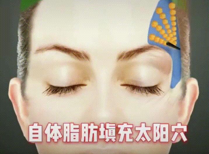 太阳穴填充的缺点跟后遗症,太阳穴填充会不会有后遗症