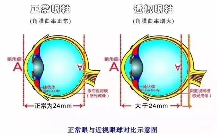 近视视觉训练用戴眼镜吗,通过视觉训练可以治疗近视吗