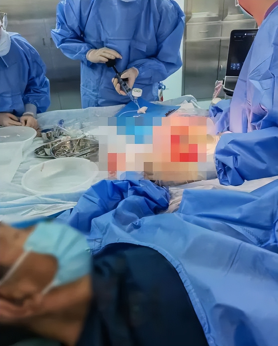 医院开展首例自体动静脉内瘘手术,自体动静脉内瘘超声评估