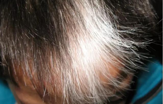 前额和头顶白发多怎么回事,右前额长白发代表什么