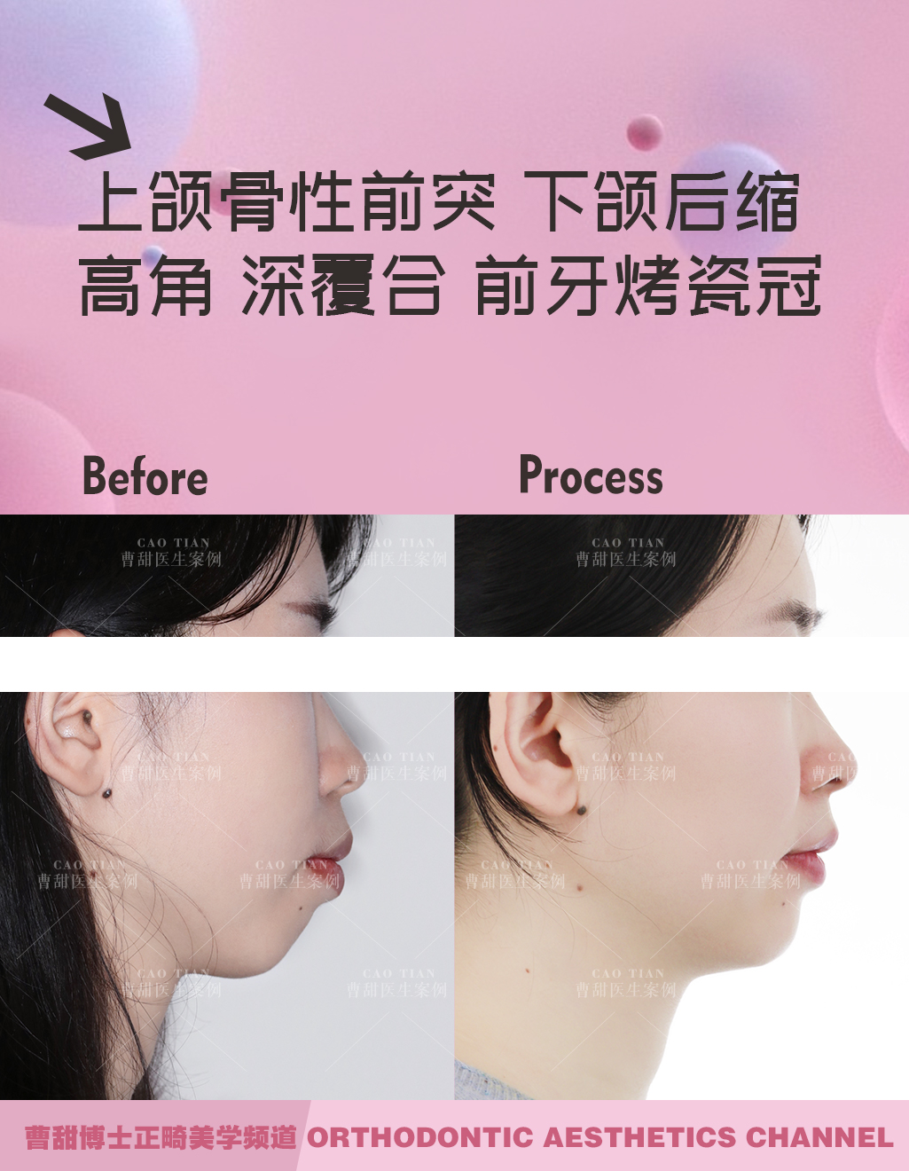 凸嘴下巴后缩拔牙改善有什么坏处,深覆合嘴凸下巴后缩矫正要拔牙吗