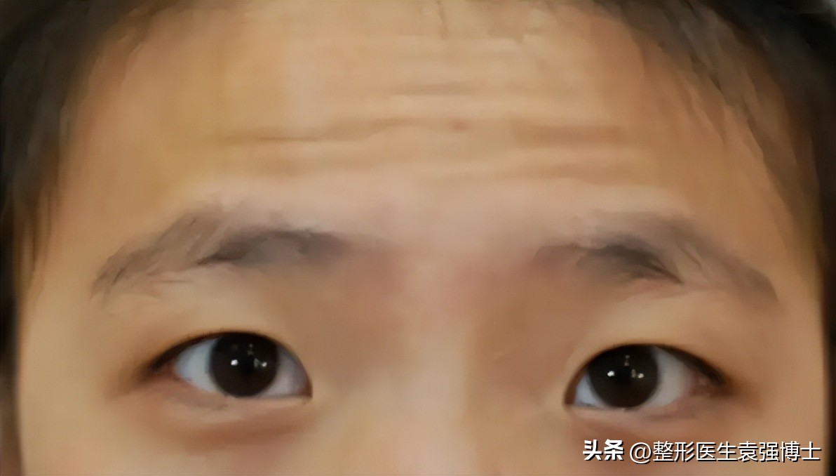 抬头纹影响运势图文,有抬头纹的人运势怎么化解