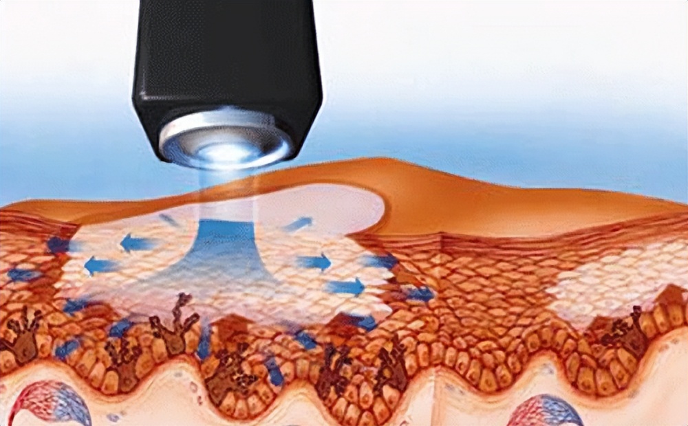 308nm准分子激光治疗白癜风,你所关心的问题都在这
