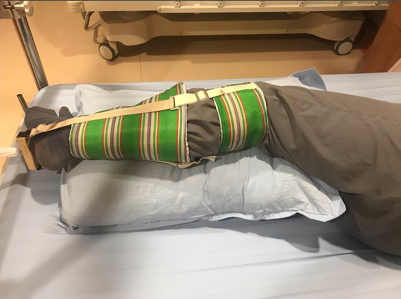 儿童股骨干粉碎性骨折对位不太好,儿童股骨干骨折石膏固定