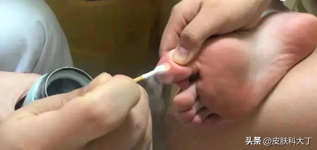 不慎感染HPV病毒长疙瘩，这种有效、价格便宜的治疗你一定要看看