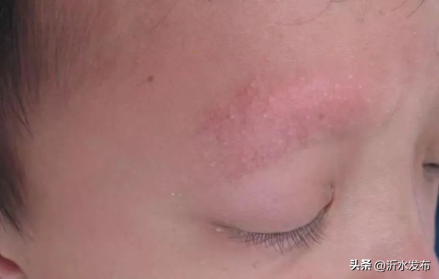 眼周长小小的疣,眼周长小丘疹是怎么回事