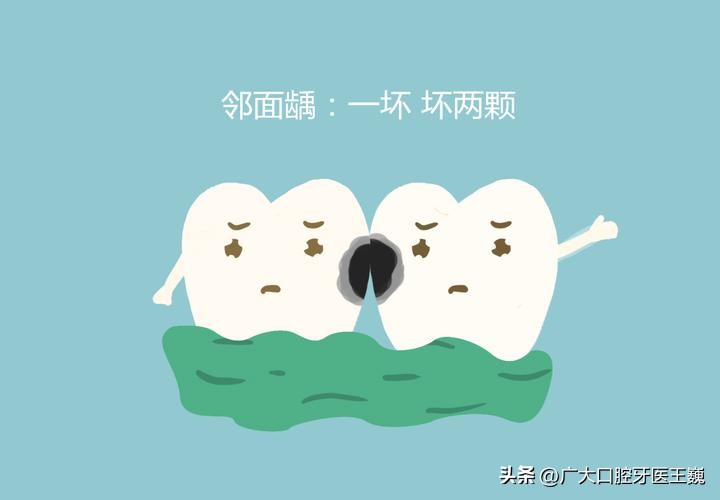 小心蛀牙,牙齿邻面龋坏轻微牙医说不用处理