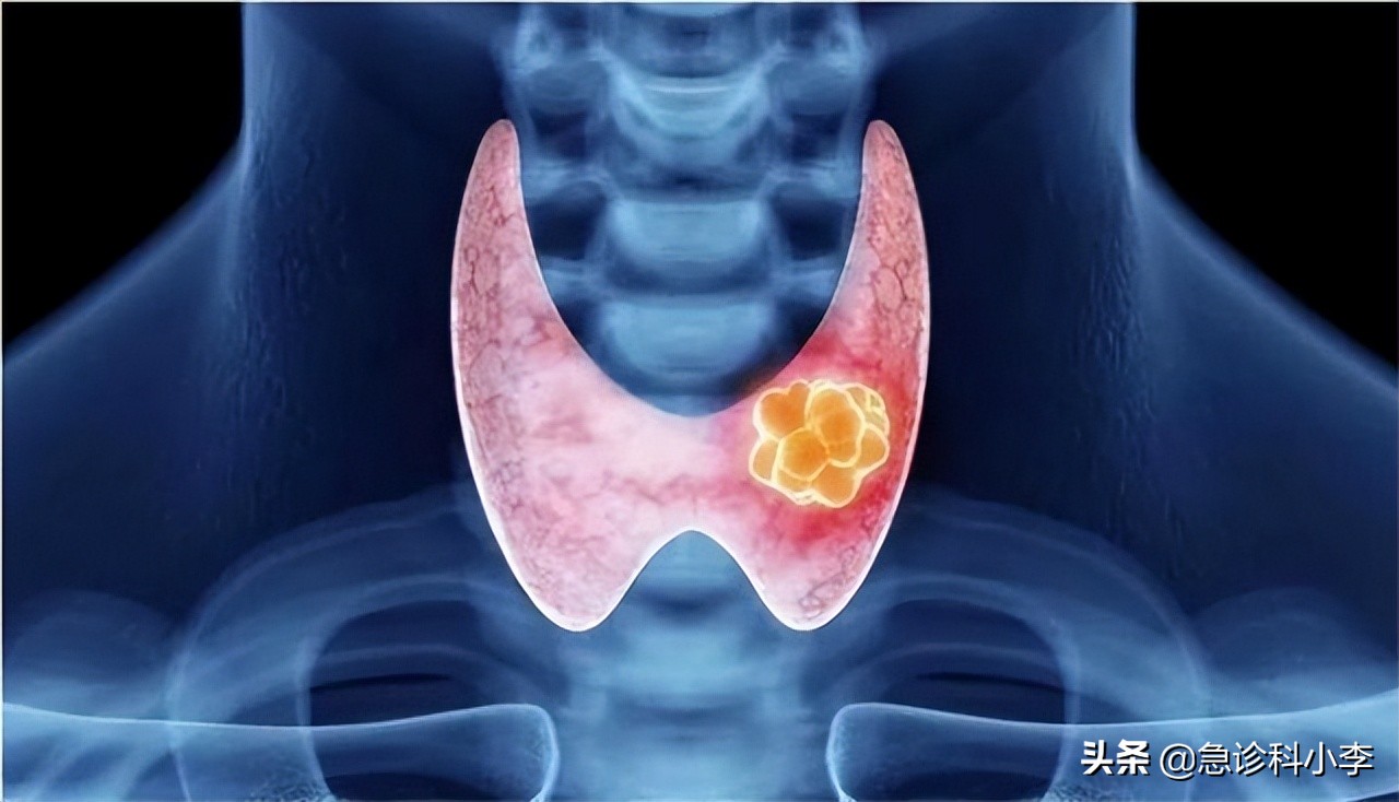 桥本氏甲状腺结节治疗的最好方法,甲状腺结节5级恶性还能治疗好吗