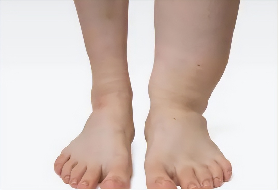 查出高尿酸这五件事再难也要坚持,高尿酸有五个表现症状图片