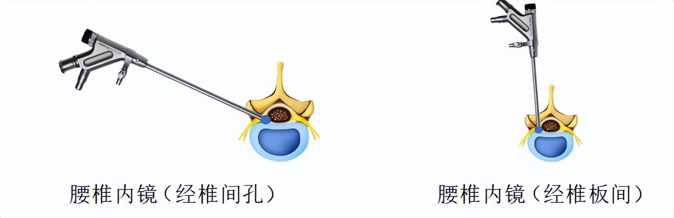 腰椎退行变性是什么原因,腰椎退变治愈的可能性